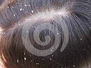 Closeup Woman with dandruff .