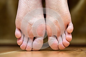 Closeup of woman feet sole with dry cracked skin. Foot and toes care concept