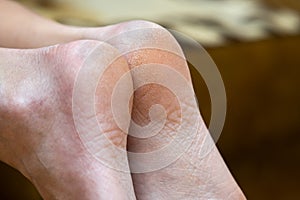 Closeup of woman feet sole with dry cracked skin. Foot and toes care concept