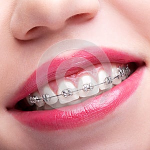 Closeup of woman open smiling mouth with brackets