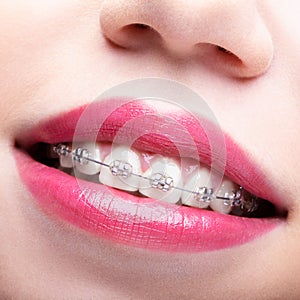 Closeup of woman open smiling mouth with brackets