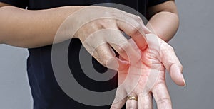 Closeup woman is scratching her hand with nails. Reddened, inflamed body parts causes discomfort and itching