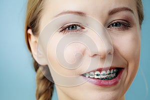 Closeup of woman teeth with braces, funny face