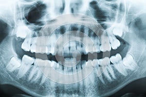 Closeup x-ray image of teeth and mouth