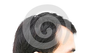 Closeup young man serious hair loss problem for hair loss concept