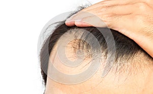 Closeup young man serious hair loss problem for hair loss concept