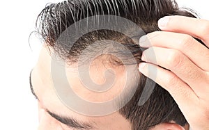 Closeup young man serious hair loss problem for health care sham