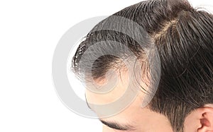 Closeup young man serious hair loss problem for health care sham