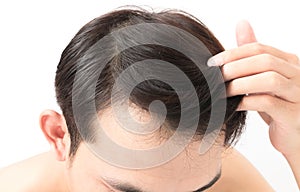 Closeup young man serious hair loss problem for health care sham