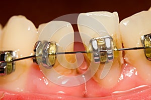 Closing of gap with dental braces