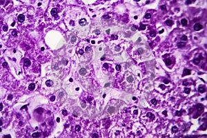 Cloudy swelling of the liver, light micrograph