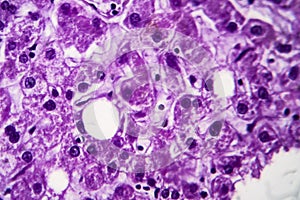 Cloudy swelling of the liver, light micrograph