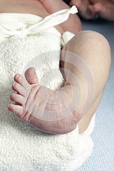 Clubfoot closeup of a newborn