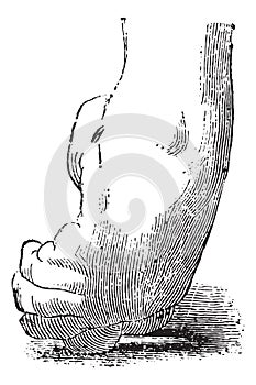 Clubfoot or congenital talipes equinovarus, vintage engraving