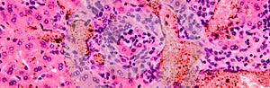 Coccidia in liver, photomicrograph showing intracellular parasitic protozoa causing hepatic coccidiosis with photo