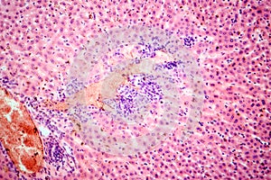 Coccidia in liver, photomicrograph showing intracellular parasitic protozoa causing hepatic coccidiosis with photo