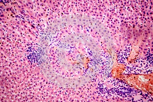 Coccidia in liver, photomicrograph showing intracellular parasitic protozoa causing hepatic coccidiosis with photo