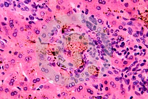 Coccidia in liver, photomicrograph showing intracellular parasitic protozoa causing hepatic coccidiosis with photo