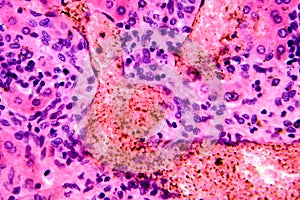 Coccidia in liver, photomicrograph showing intracellular parasitic protozoa causing hepatic coccidiosis with photo