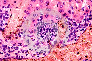 Coccidia in liver, photomicrograph showing intracellular parasitic protozoa causing hepatic coccidiosis with photo