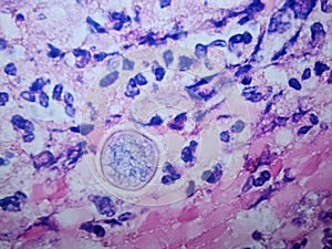 Coccidioides imitis spherule on H and E pathology specimen