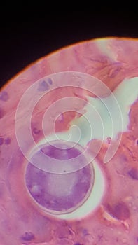 Coccidioides imitis spherule in skin biopsy specimen photo