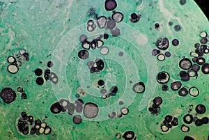 Coccidioides imitis spherules on GMS pathology specimen photo