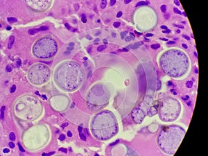 Coccidioides imitis spherules on H and E pathology specimen