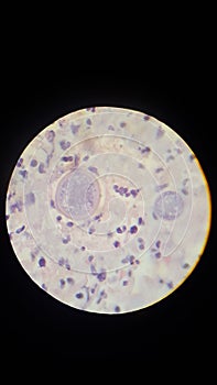 Coccidioides imitis spherules in skin biopsy specimen photo