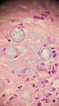 Coccidioides imitis spherules in skin biopsy specimen photo