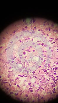 Coccidioides imitis spherules in skin biopsy specimen photo
