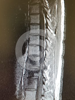 Coccidioides imitis Vertebral Osteomyelitis with Prevertebral Abscess