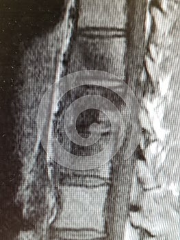 Coccidioides imitis Vertebral Osteomyelitis with Prevertebral Abscess photo