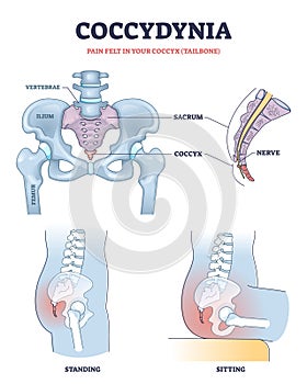 Coccydynia as pain felt in coccyx or tailbone anatomical outline diagram photo