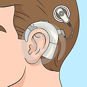 Cochlear implant diagram medical science