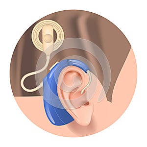 Cochlear implant. Hearing aid in the ear.