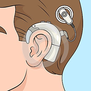 Cochlear implant diagram medical science photo