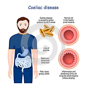 Coeliac disease. celiac autoimmune disorder