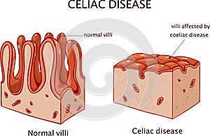 Coeliac disease or celiac disease. small bowel showing coeliac d