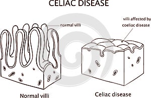 Coeliac disease or celiac disease. small bowel showing coeliac d