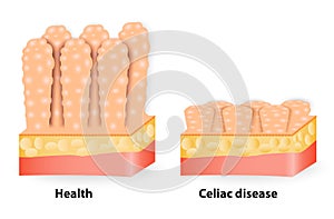 Coeliac disease or celiac disease photo