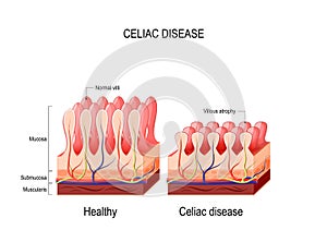 Coeliac disease. celiac disease. photo