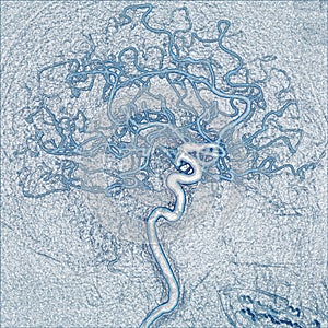 Coiling of the cerebral aneurysm, angiography