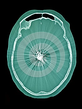 Coiling cerebral aneurysm CT