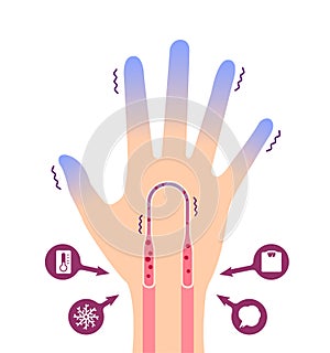 Cold hand blood circulation illustration sensitivity to cold, cold fingertips