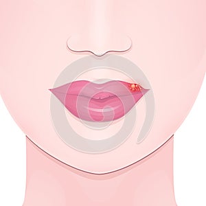 Cold sore lip photo