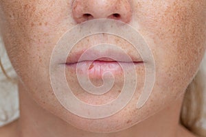 Cold sore on womans lip