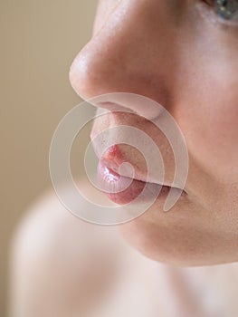 Cold sores. Close-up of the female face.