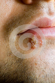 Frío úlceras (labial) 