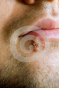 Cold sores (herpes labialis)